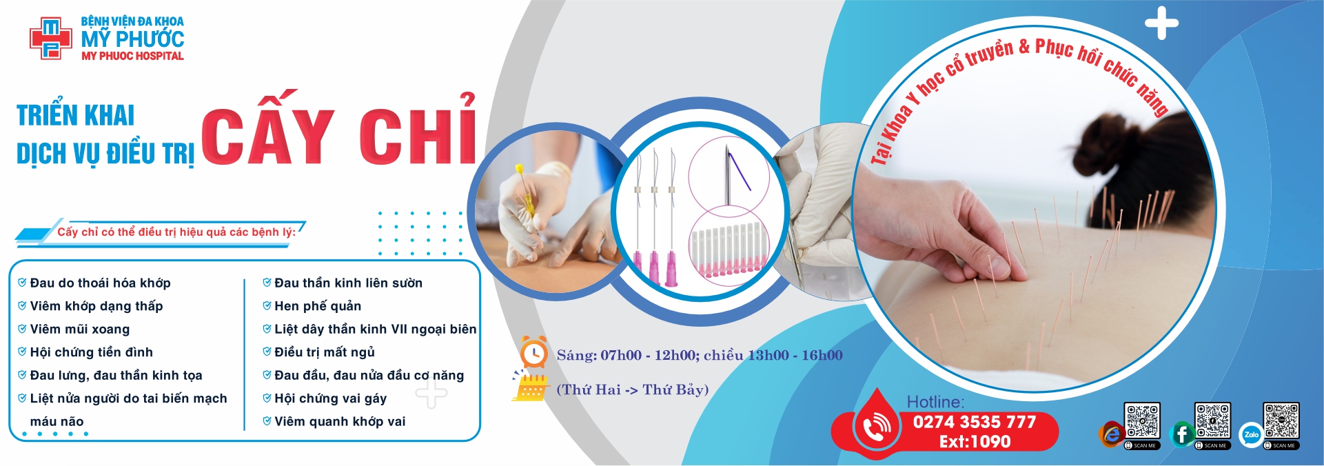 DỊCH VỤ CẤY CHỈ