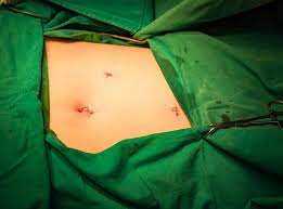 Phẫu thuật nội soi cắt túi mật cần chú ý gì? - Nhà thuốc FPT Long Châu