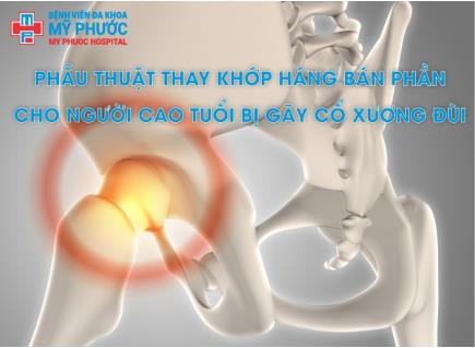 PHẪU THUẬT THAY KHỚP HÁNG BÁN PHẦN CHO NGƯỜI CAO TUỔI BỊ GÃY CỔ XƯƠNG ĐÙI