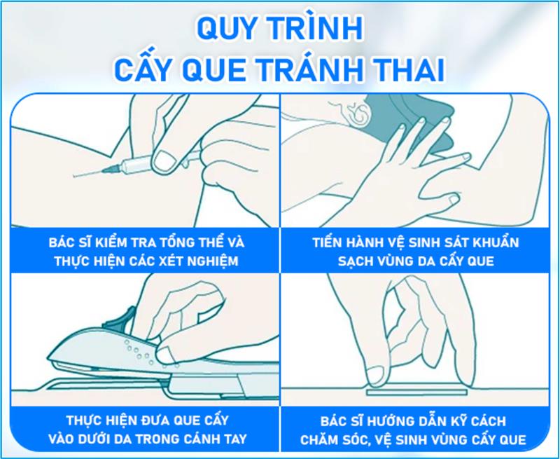 So Sánh Que Cấy Tránh Thai với Các Phương Pháp Tránh Thai Khác